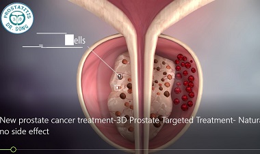 Prostatitis 3A típus Prosztata kezelés 25 év alatt