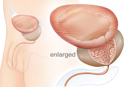 Enlarged Prostate