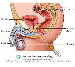 Prostate Cancer Treatment