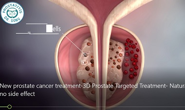 Prostate Cancer Treatment